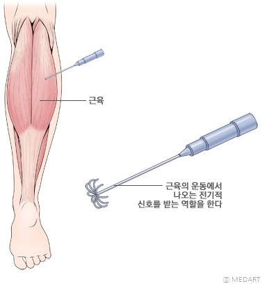 바늘을 사용한 근전도 검사의 한 장면