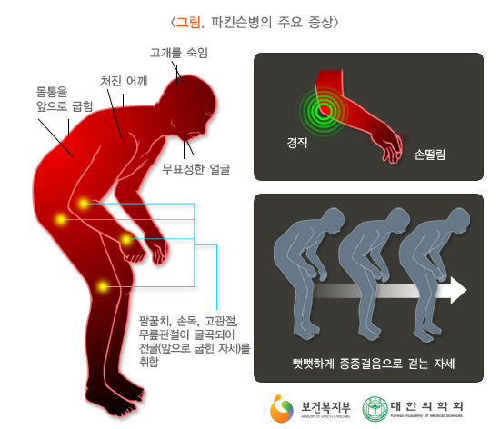 파킨슨병의 주요 증상