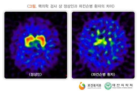 핵의학 검사 상 정상인과 파킨슨병 환자의 차이