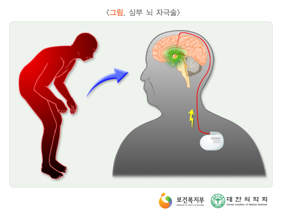 심부 뇌 자극술