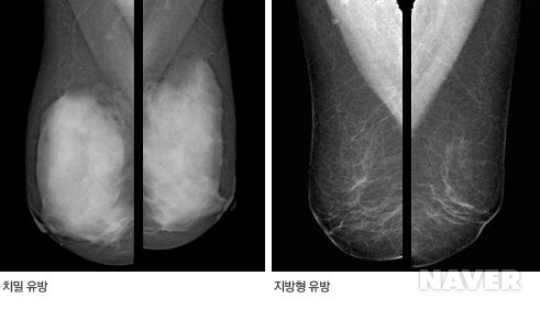 유방 촬영 사진