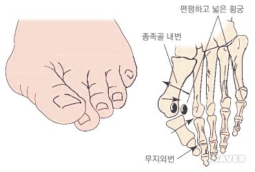 무지외반증