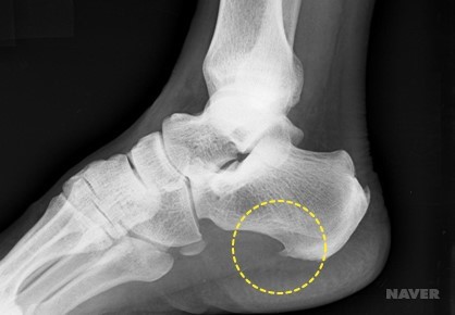 족저근막염 X선 영상: 발뒤꿈치뼈에 뼈조각이 자라남