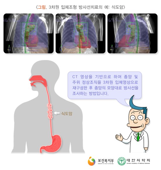 3차원 입체조형 방사선치료의 예: 식도암