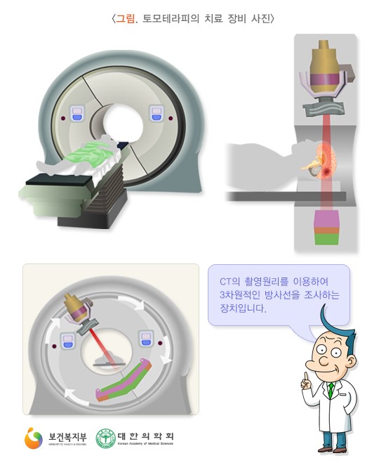토모테라피의 치료 장비 사진