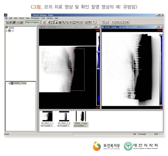 모의 치료 영상 및 확인 찰영 영상의 예: 유방암