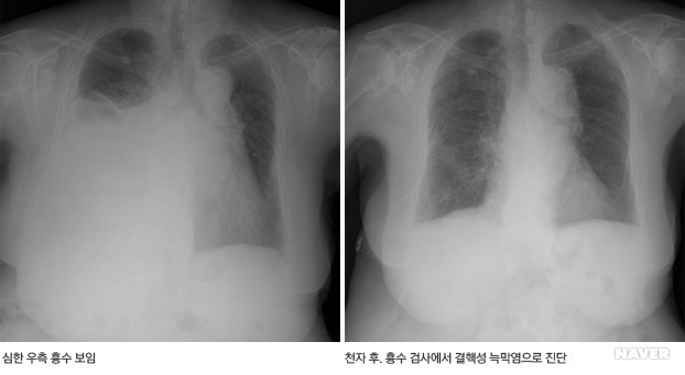 흉수 X선 영상