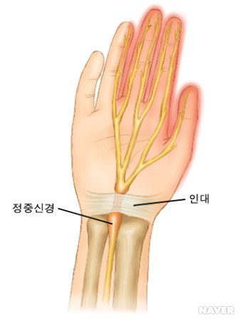 손목굴 증후군에서 통증이 나타나는 부위
