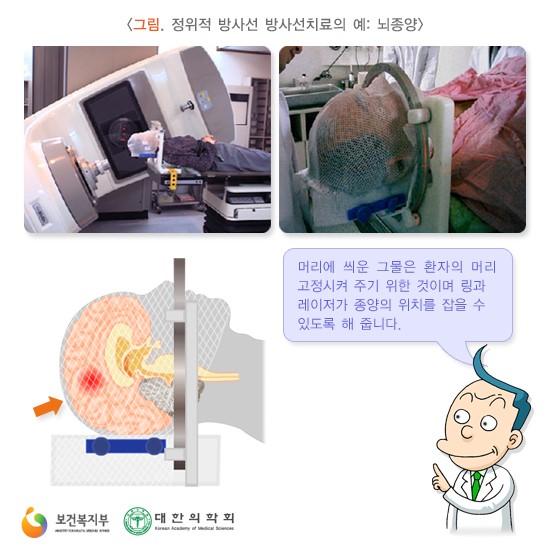 정위적 방사선 방사선치료의 예: 뇌종양