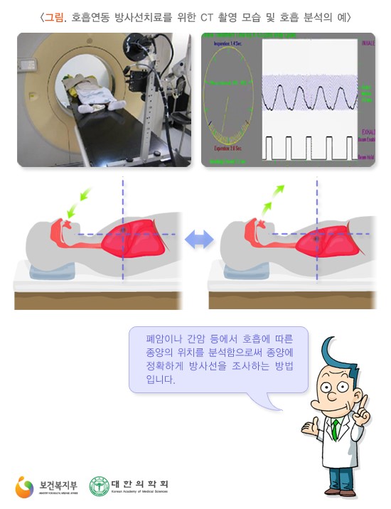 호흡연동 방사선치료를 위한 CT 촬영 모습 및 호흡 분석의 예