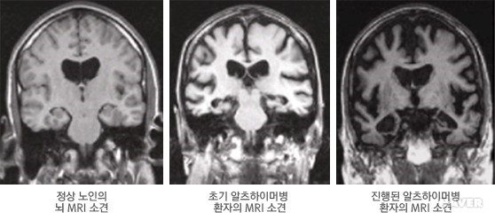 알츠하이머병 MRI 영상