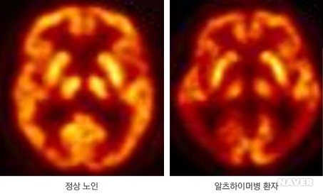 알츠하이머병 PET 영상