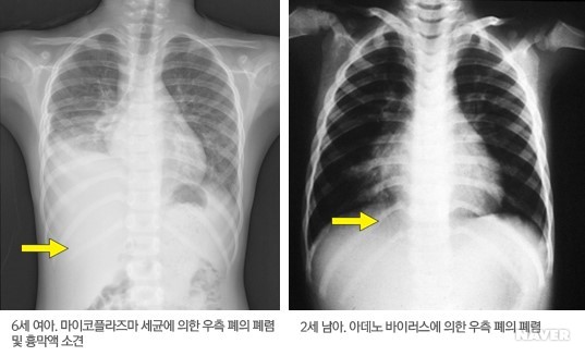 소아 폐렴