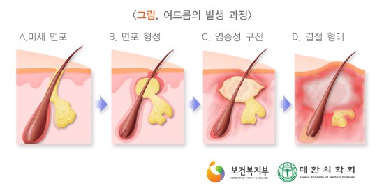 여드름의 발생 과정