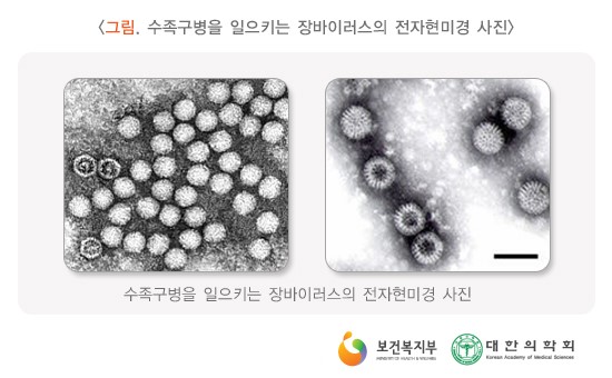 수족구병을 일으키는 장바이러스의 전자현미경 사진