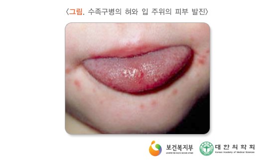 수족구병의 혀과 입 주위의 피부 발진