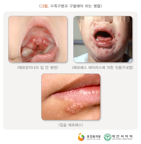 수족구병과 구별해야 하는 병들