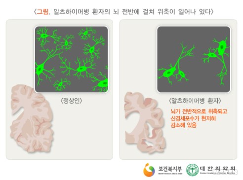 알츠하이머병 환자의 뇌 전반에 걸쳐 위축이 일어나 있다