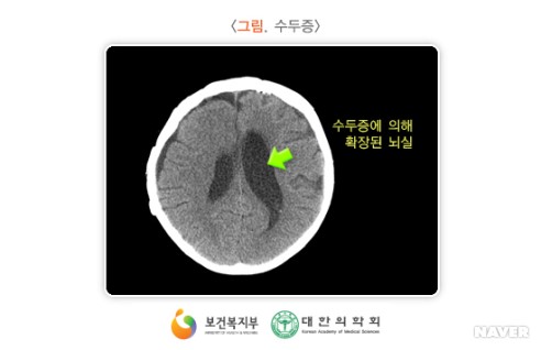 수두증
