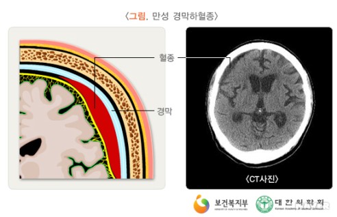 만성 경막하혈종