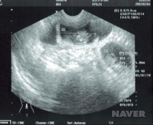 자궁 초음파 사진