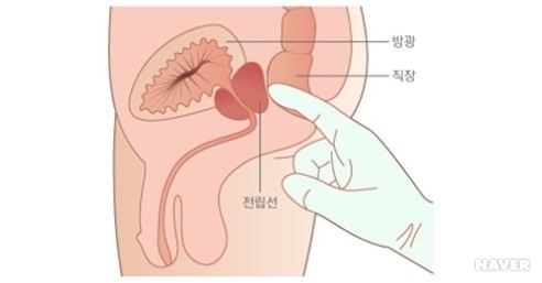 [그림 3]  직장수지검사
