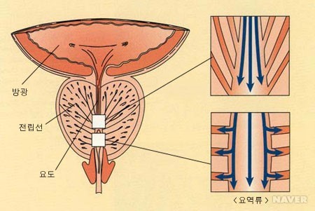 전립선염 증후군 본문 이미지 1